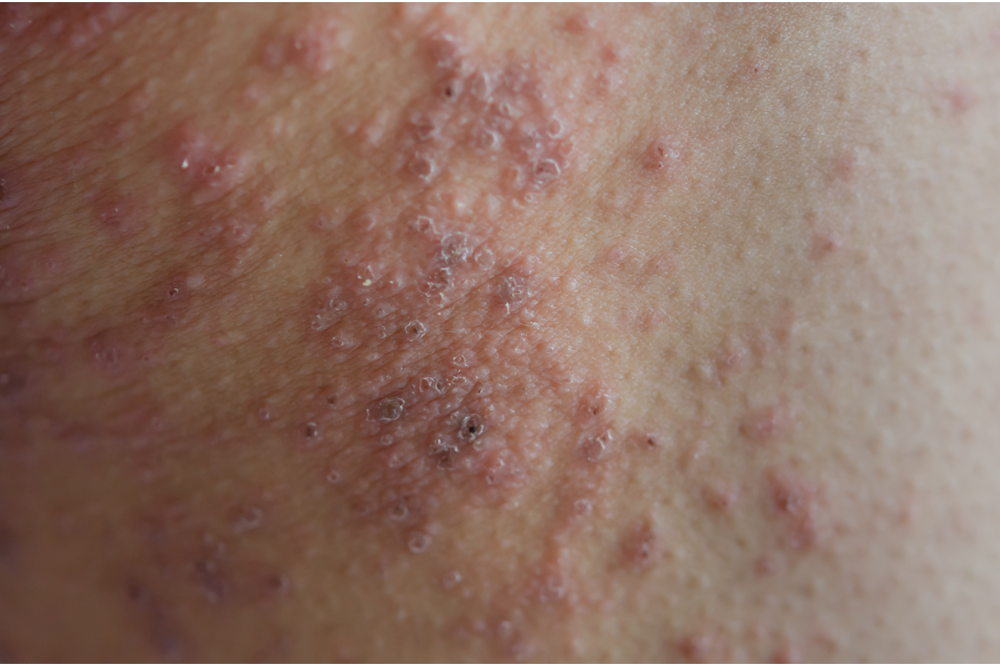allergies (2) allergies