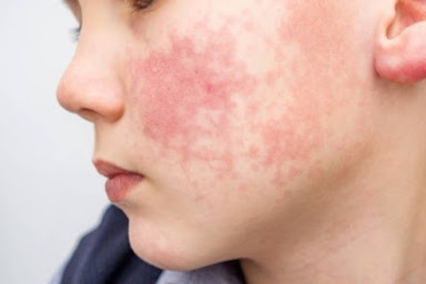 allergy treatment allergy treatment